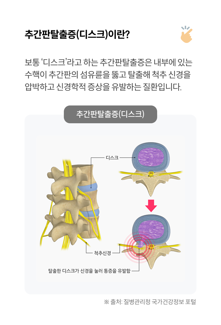 추간판탈출증(디스크)이란?