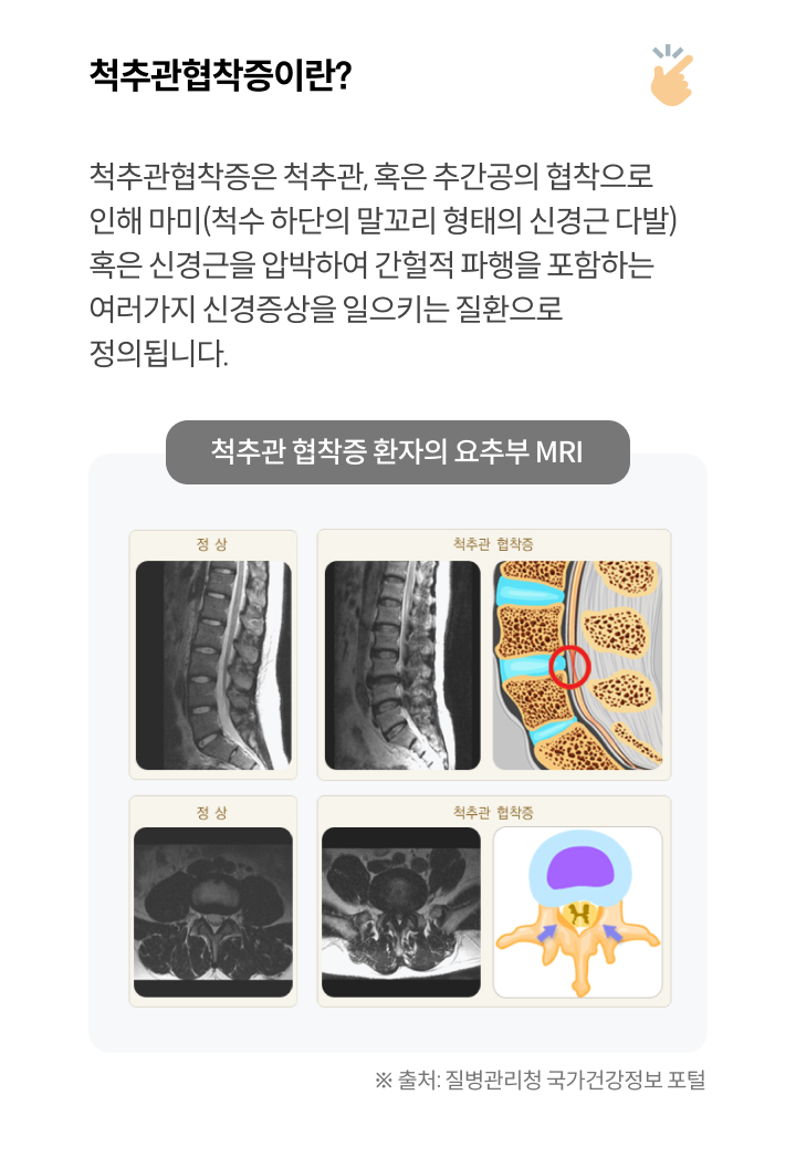 척추관협착증이란?