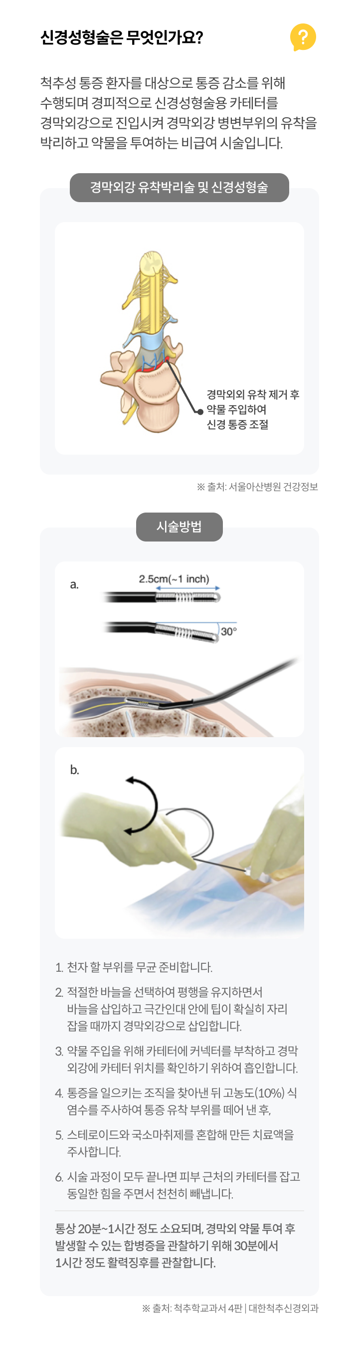 신경성형술은 무엇인가요?