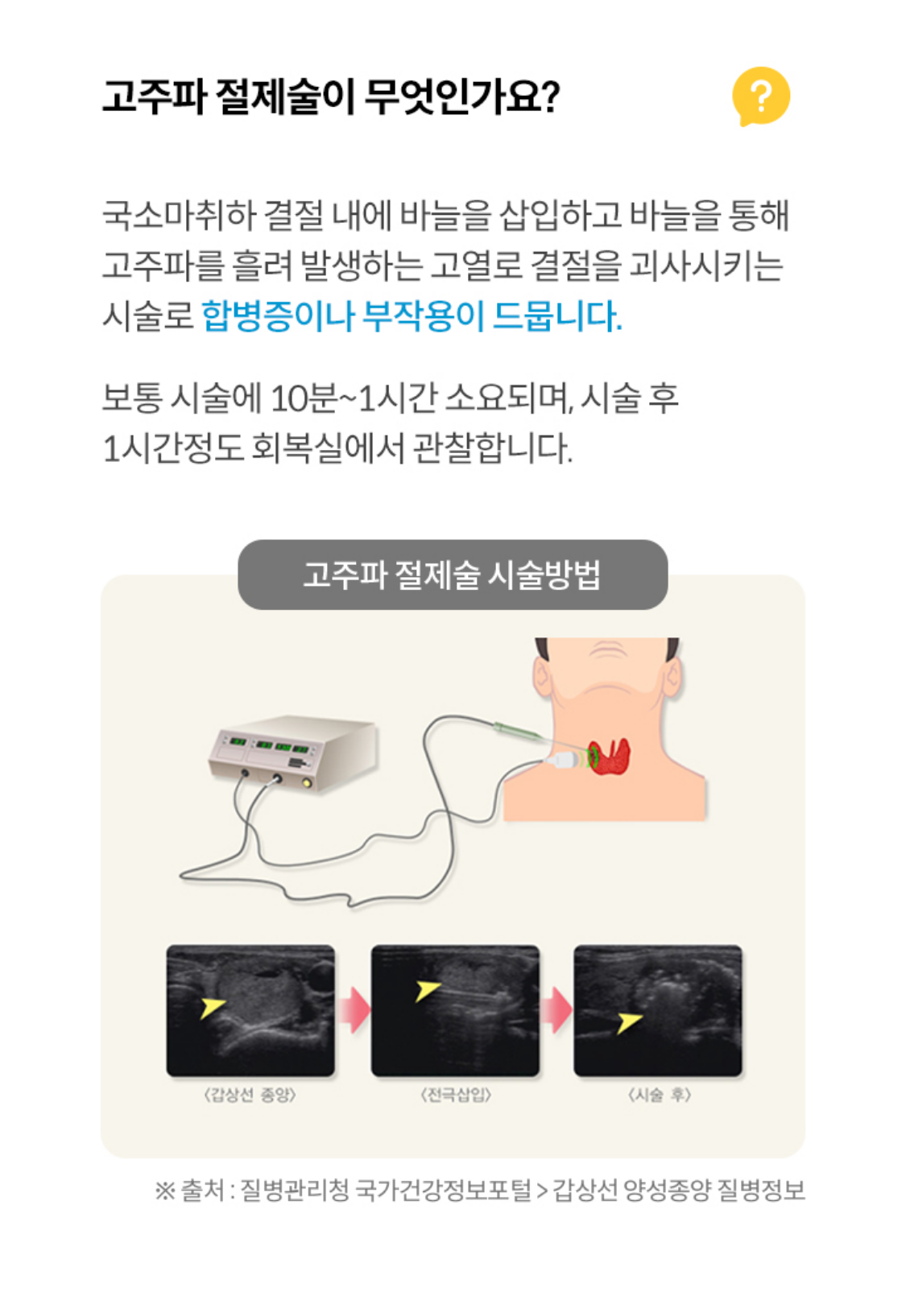 고주파 절제술이 무엇인가요?