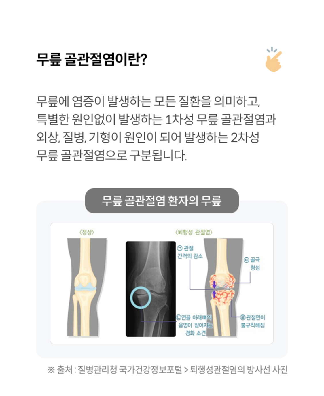 무릎 골관절염이란?