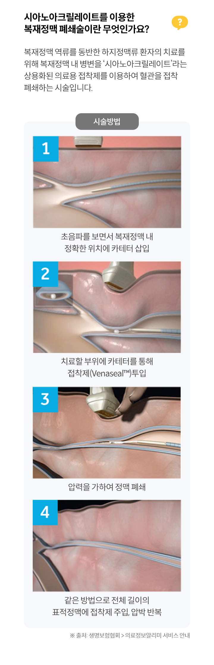시아노아크릴레이트를 이용한
복재정맥 폐쇄술이란 무엇인가요?